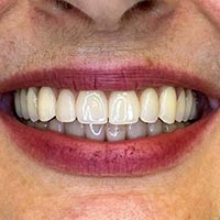 Képek fogászati kezeléseinkről - Teljes implantácio és csontpótlás