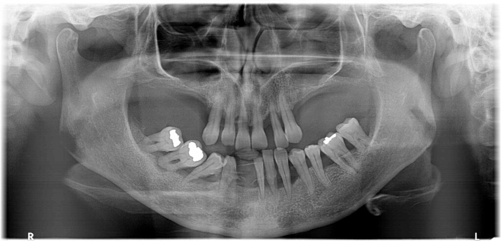 Röntgen a fogak eredeti állapotáról!