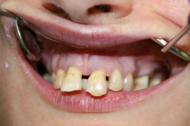 A fogak eredeti állapota