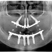 Implantációs fogpótlás - teljes rehabilitáció