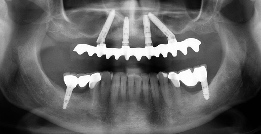 Implantátumok a röntgenen.