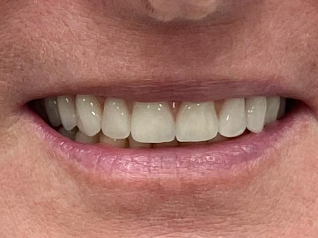 Teljes felső fogsor rehabilitációja implantátumokkal