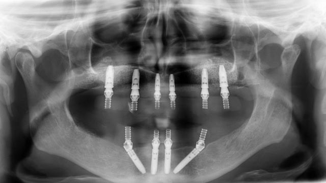 Röntgen az implantációt követően az ideglenes pótlással