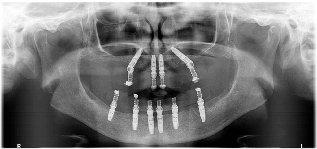 Röntgen az implantáció után.