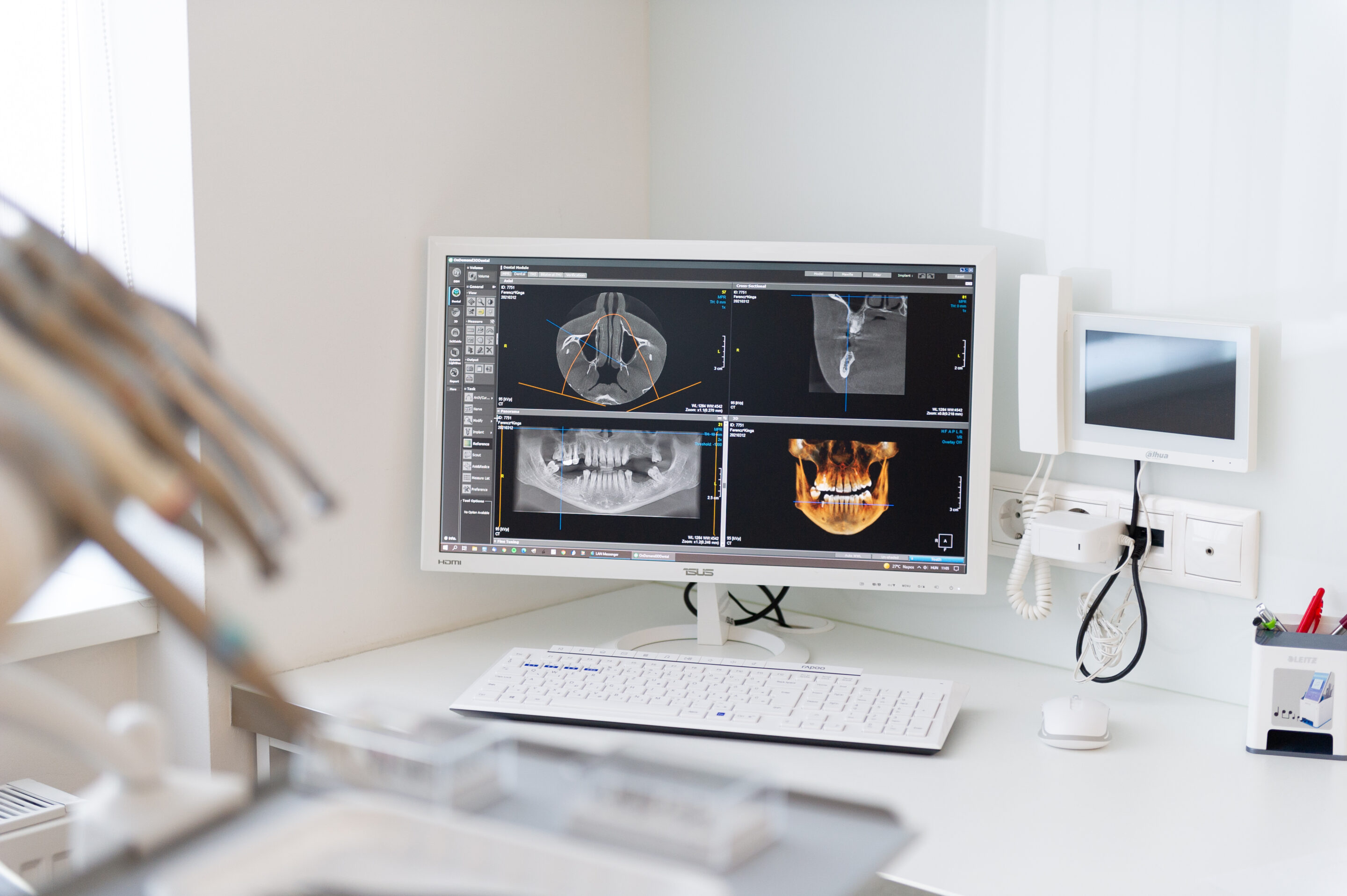 Teljes felső fogsor rehabilitációja implantátumokkal