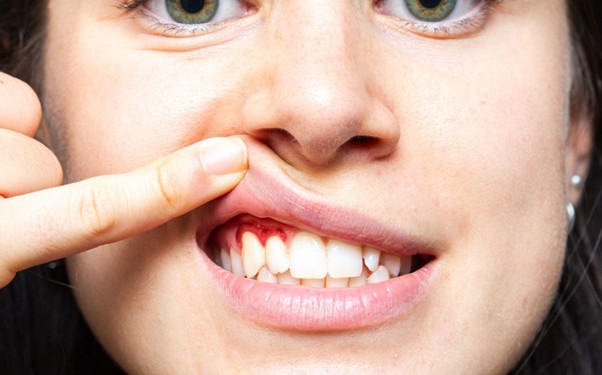 Fogínyvérzés mikor forduljunk fogorvoshoz