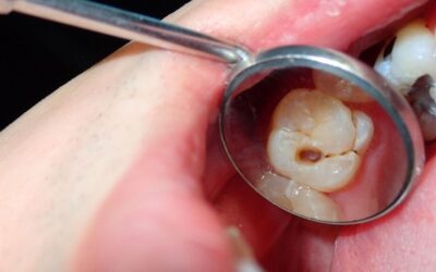 Fogszuvasodás megelőzése: 7 szokás, amit a fogorvosok is ajánlanak