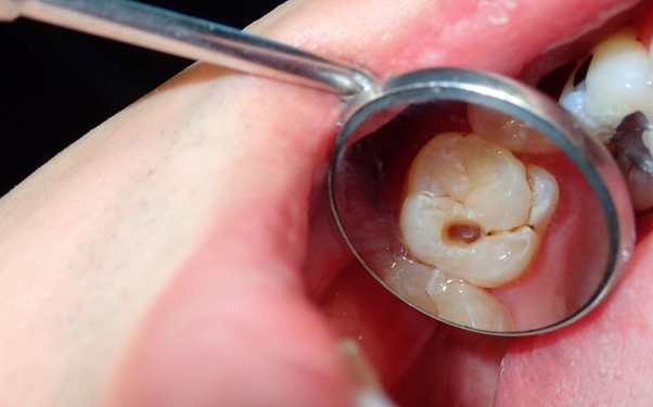 Hogyan előzhető meg a fogszuvasodás