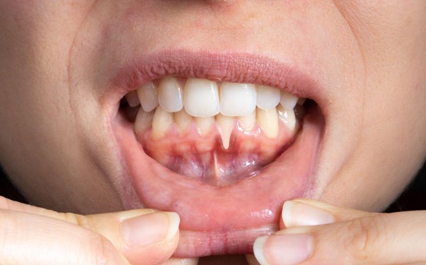 Mikor probléma a fogínyvérzés