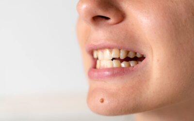 Miért sárgulnak a fogak, és mit tehetünk ellene?